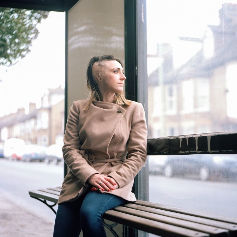 A woman with burns on her head sitting at a bus stop