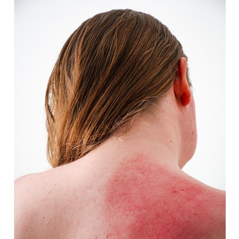 A photograph of the back of a woman with inflamed skin on her shoulder