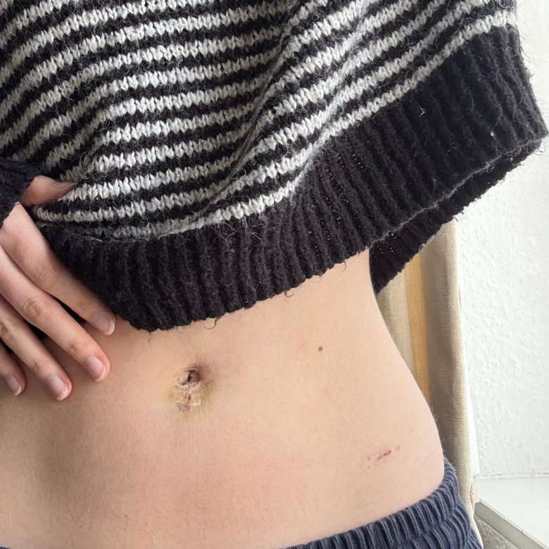 Photo of a hand touching bruised tummy button with striped jumper rising up