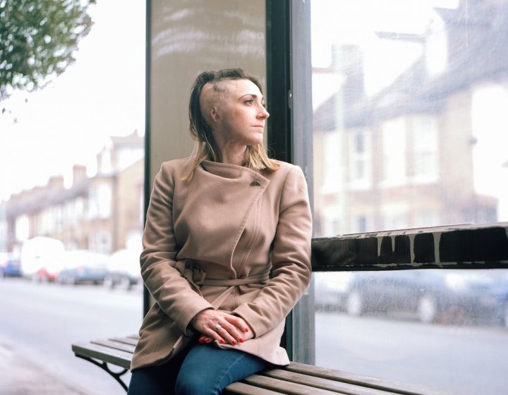 A woman with burns on her head sitting at a bus stop