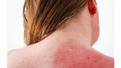A photograph of the back of a woman with inflamed skin on her shoulder