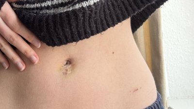 Photo of a hand touching bruised tummy button with striped jumper rising up