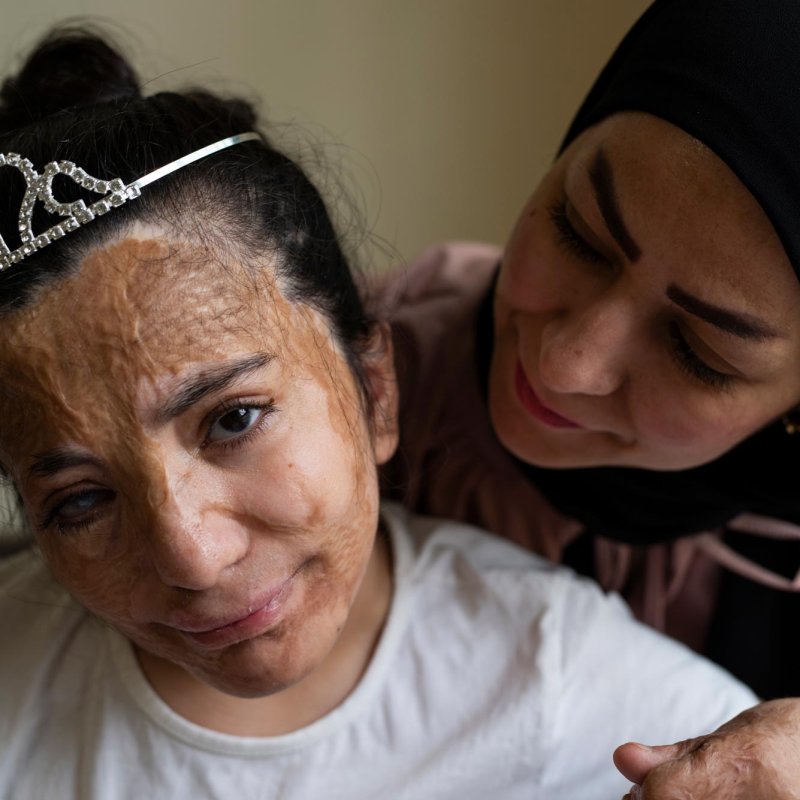 A young girl with scaring on her face, wearing a tiara, with a woman behind her